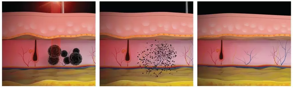 picosecond laser